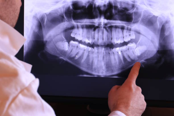 Best Knocked-Out Tooth (Avulsed Tooth) Treatment in South Sarasota, FL